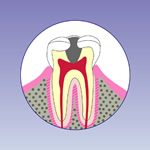 虫歯の後期段階（C3）