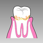 歯周病（初期）